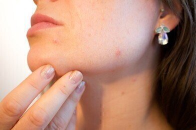 Can Acne Be Prevented?